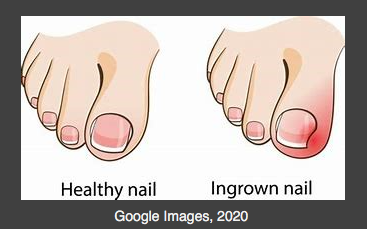 What is an ingrown toenail and why do they happen?